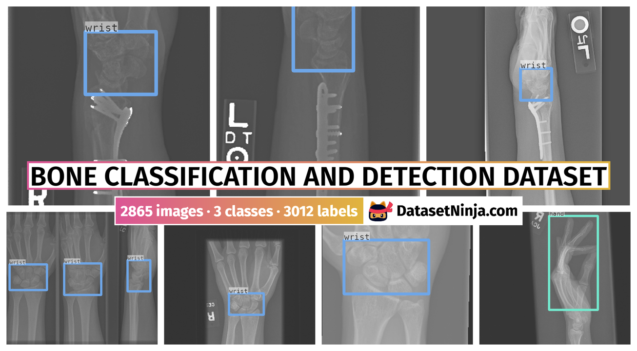 Bone Classification and Detection Dataset - Dataset Ninja