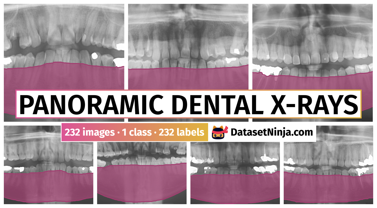 Panoramic Dental Xrays Dataset Ninja