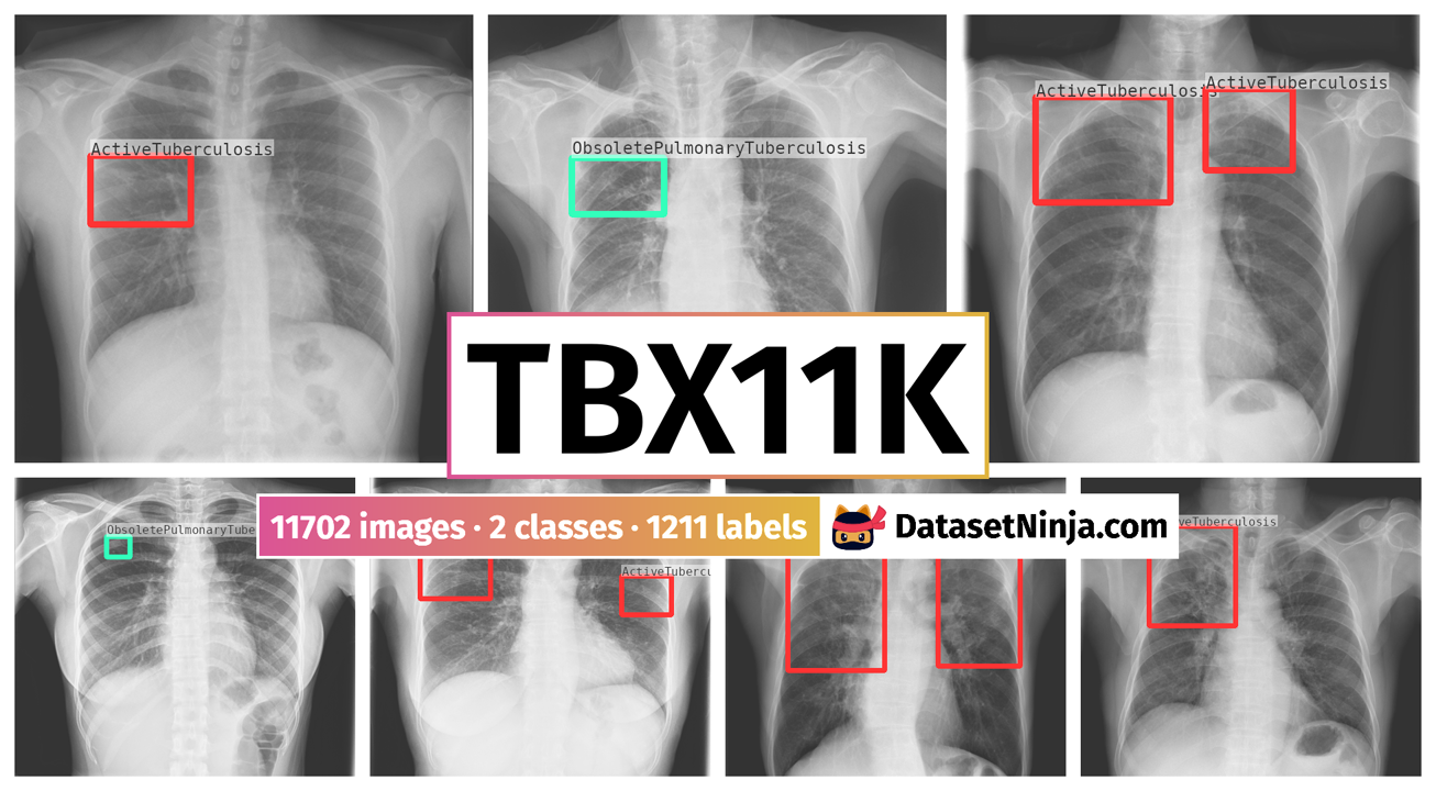 健康・医学 Tuberculosis TBX11K - Dataset Ninja